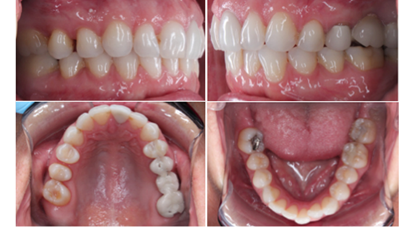 Overbite Correction with Invisalign Redondo Beach CA - Aligners