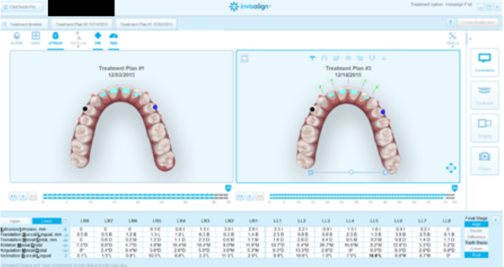 Clincheck's Reviewed by an orthodontist through Aligner Concierege ...
